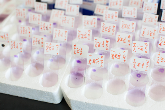 Blood stage malaria slides are used to count how many parasites are contained in each blood smear inside the lab at USF.